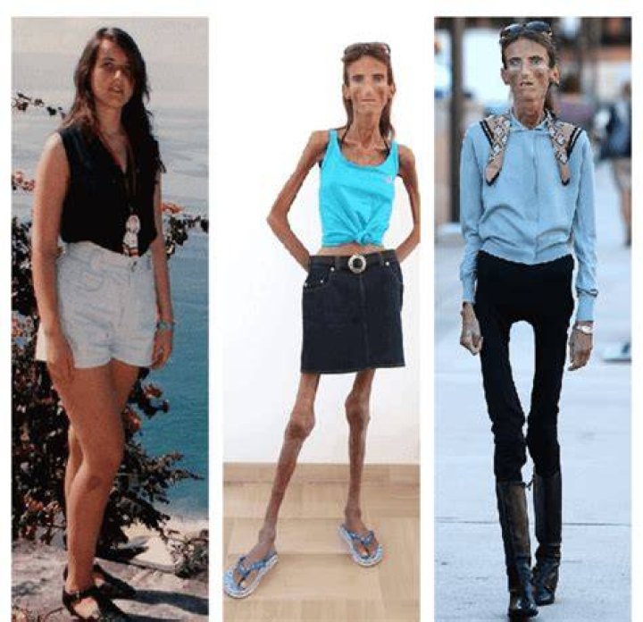 Who&rsquo;s the Skinniest Person in the World: Unveiling the Truth